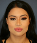 Feel Beautiful - Rhinoplasty 223 - After Photo